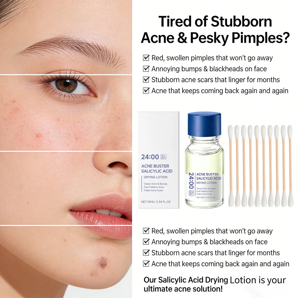 Salicylic Acid Drying Lotion Face Serum with Cotton Swab– Reduce Pimples & Breakouts Fade Acne Scars Minimize Pores Skin Renewal